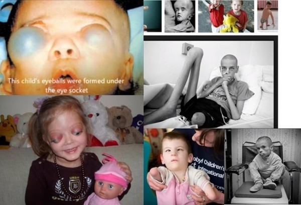 This child's eyes were formed under the eye sockets! Look What Nuclear Industry Does to our Eyes& Bodies: Nuclear industry slowly murders us with everyday low level reactor emissions that add up and can be more deadly than high-level catastrophic disasters as seen in these pictures of child victims of Chernobyl. 