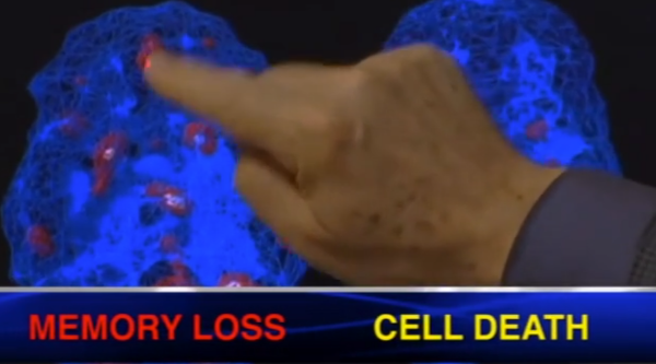 Brain damage from close proximity to cell phone towers