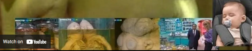 Russia, Kazakhstan, nuclear testground babies Russia, Kazakhstan, nuclear testground babies