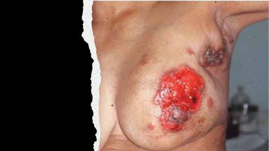 Cancer of the breast