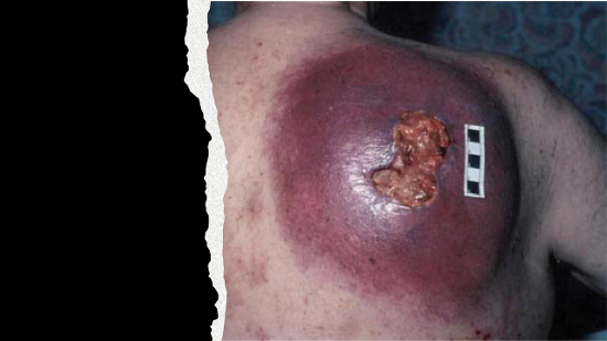 Cancer on the back